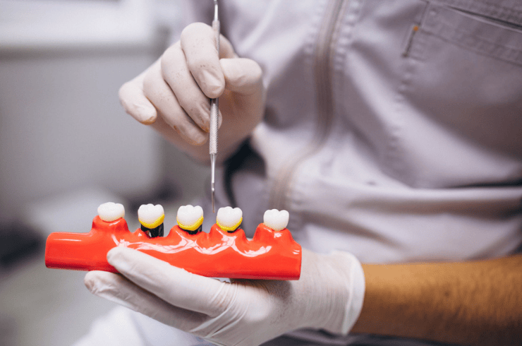 Dental Crowns & Bridges