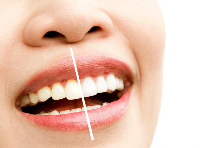 Teeth whitening