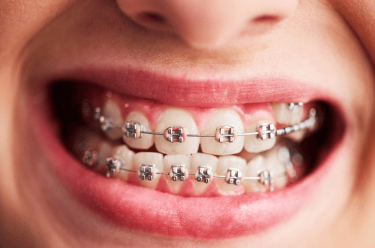 Orthodontics (Braces)