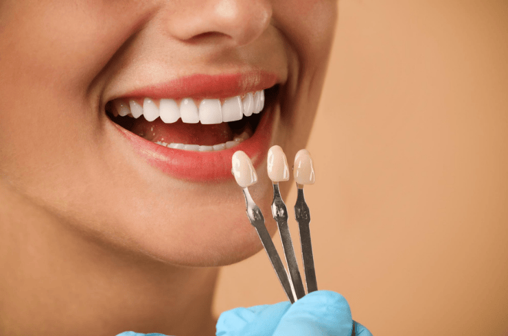 Veneers